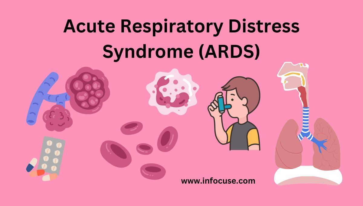 Acute Respiratory Distress Syndrome