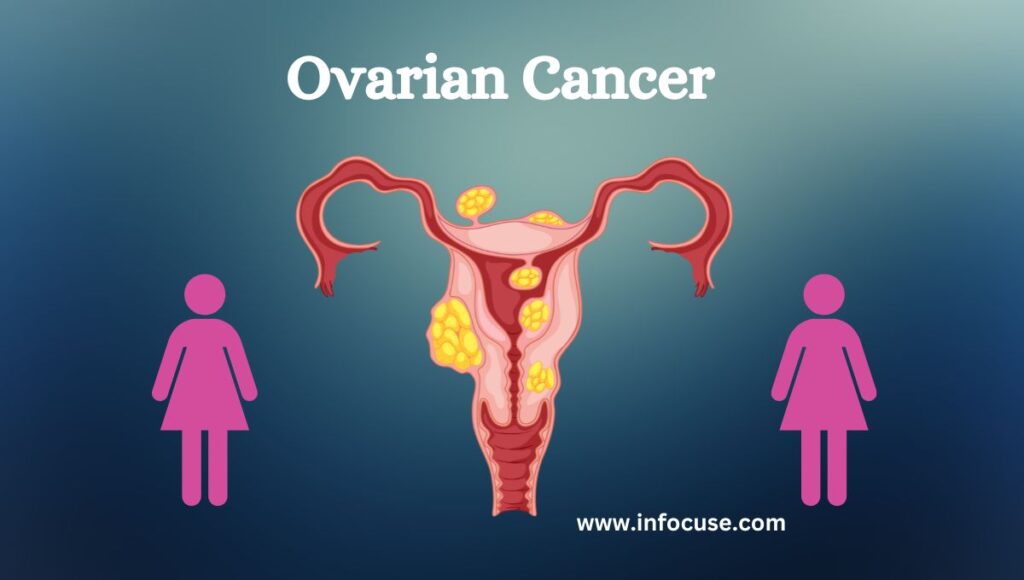 ovarian cancer