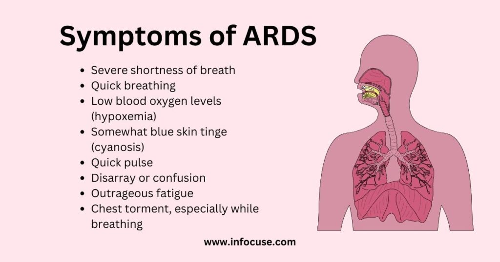 Acute Respiratory Distress Syndrome - Symptoms of ARDS